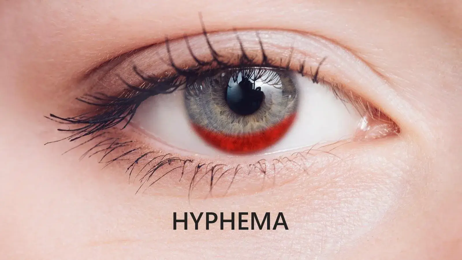 What Is Hyphema?