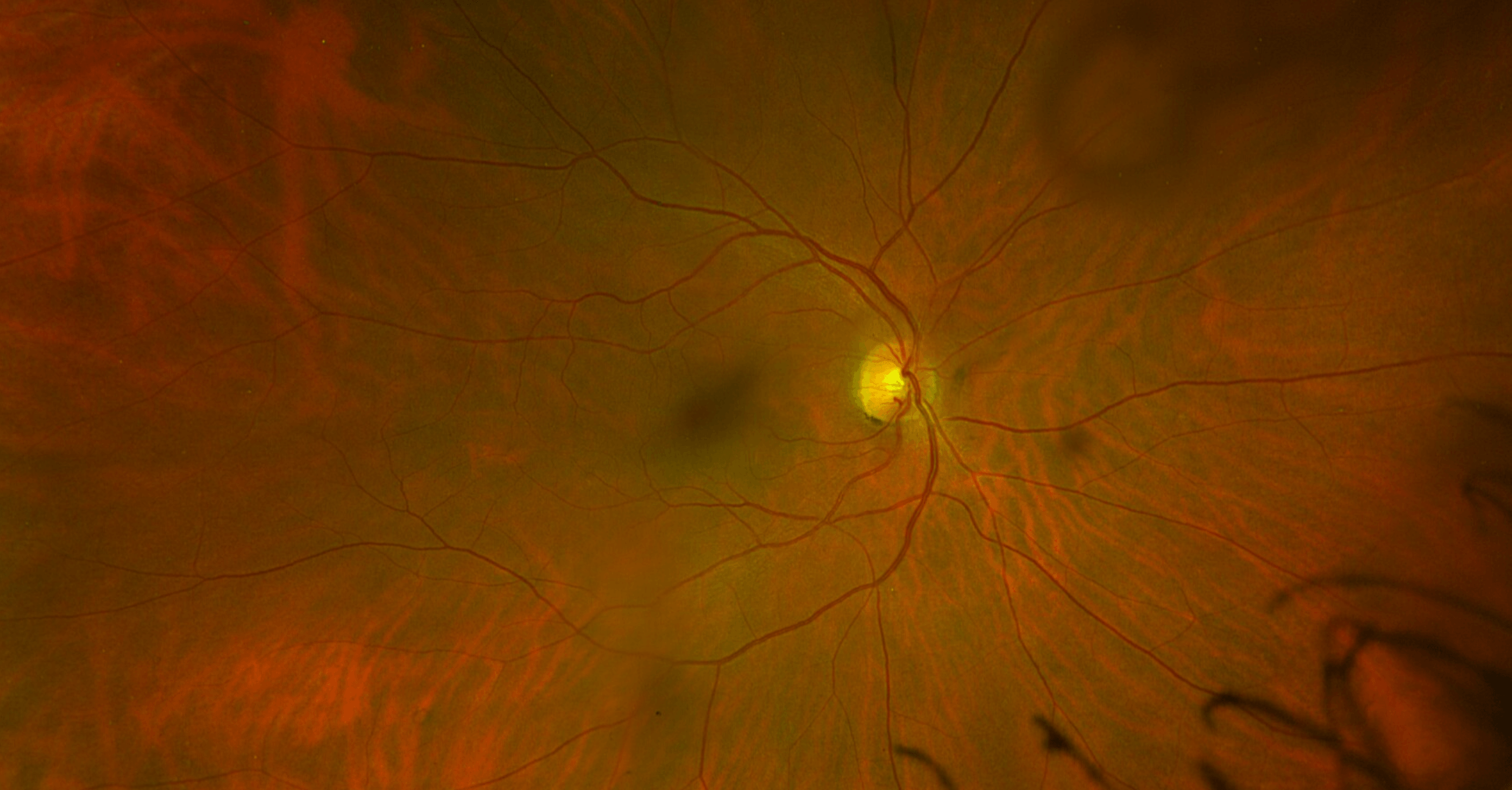 Color fundus photograph using optos opto map of the right eye showing the absence of an epiretinal membrane. The patient's other eye has an epiretinal membrane.