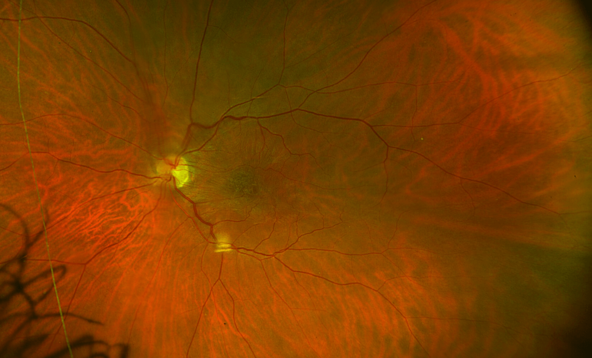 Color fundus photograph using the optos opto map of the left eye, showing an epiretinal membrane with contraction of the macula, causing distortion, blurry vision, macropsia, or bigger images in this eye compared to the other eye and central peripheral rivalry. Our image is jumping around between the eyes and having to close the left eye to see better out of the fellow eye.