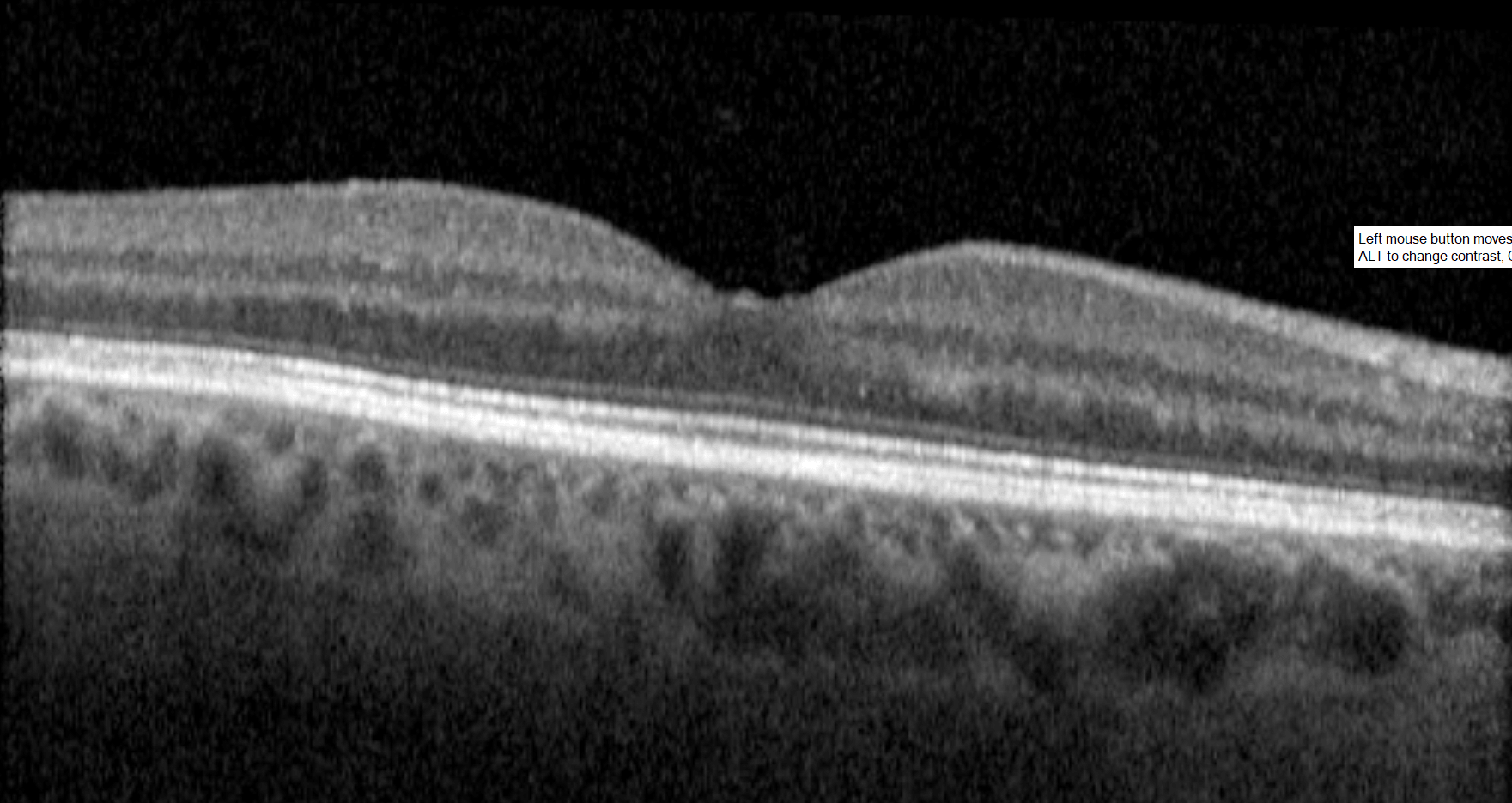 Optical coherence tomogram or OCT of the normal macula of the right eye.